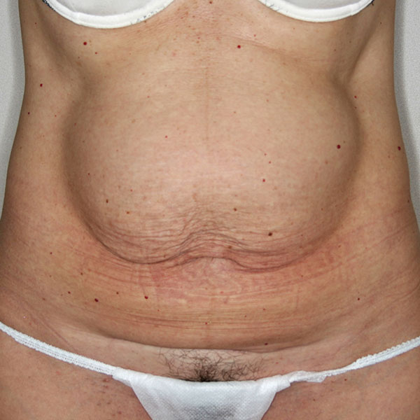 Antes - corporales frontal