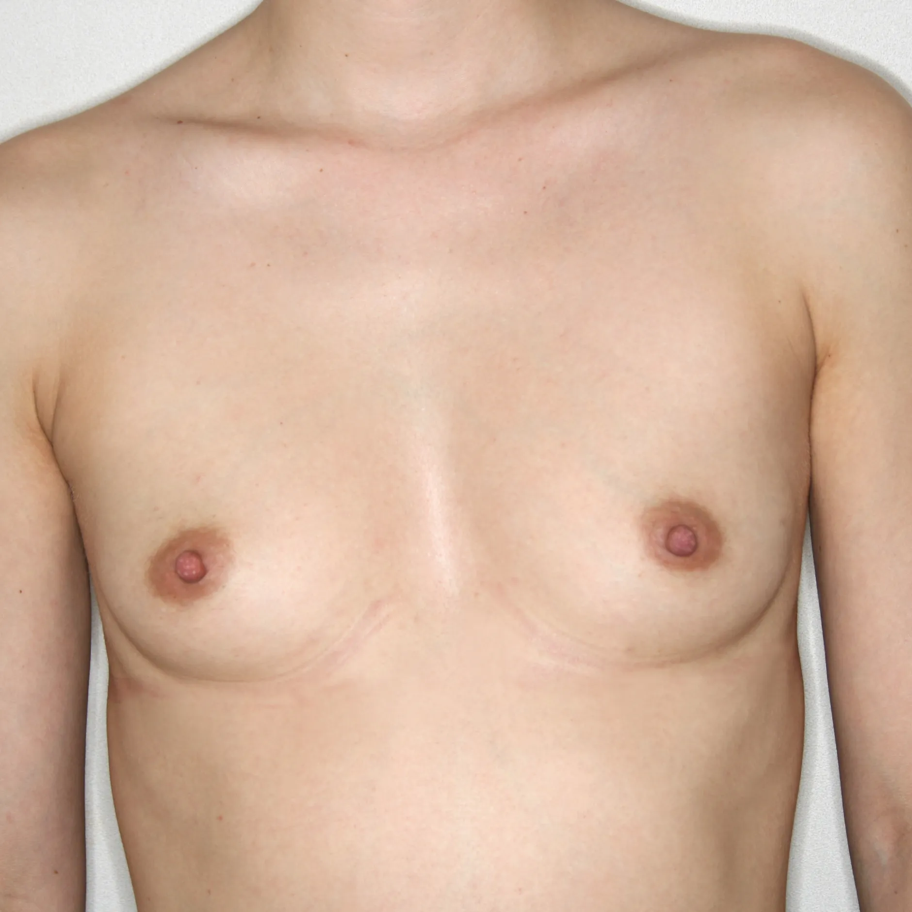 Antes - Aumento de pecho