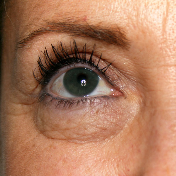 Antes - Blefaroplastia