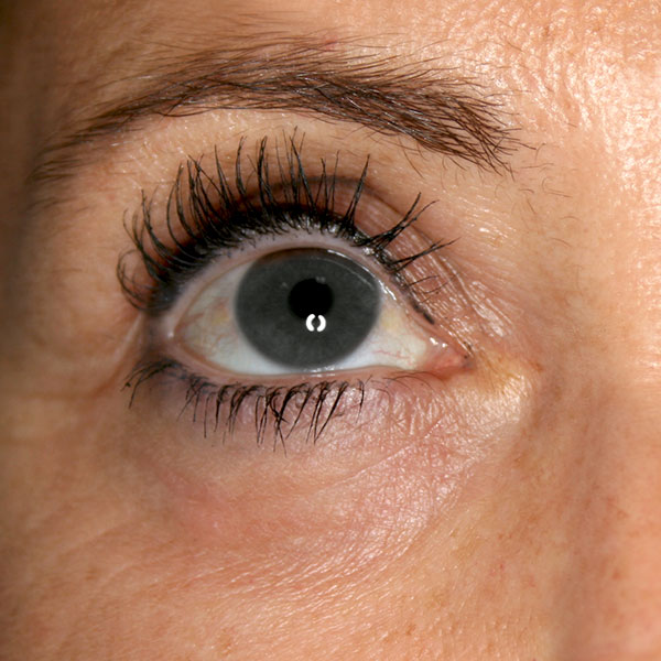 Después - Blefaroplastia