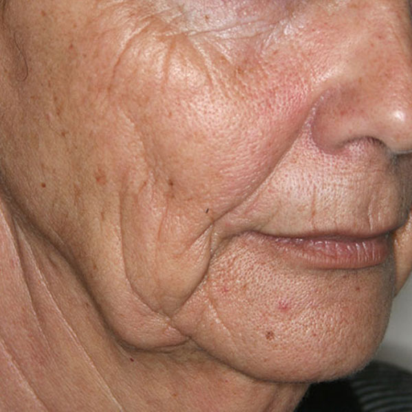 Antes - Lifting facial