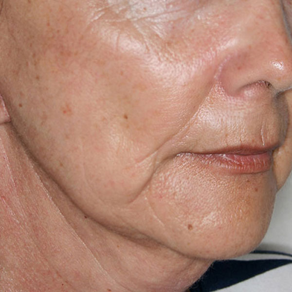 Después - Lifting facial