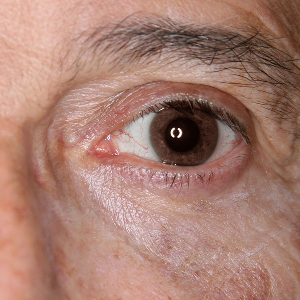 Después - blefaroplastia