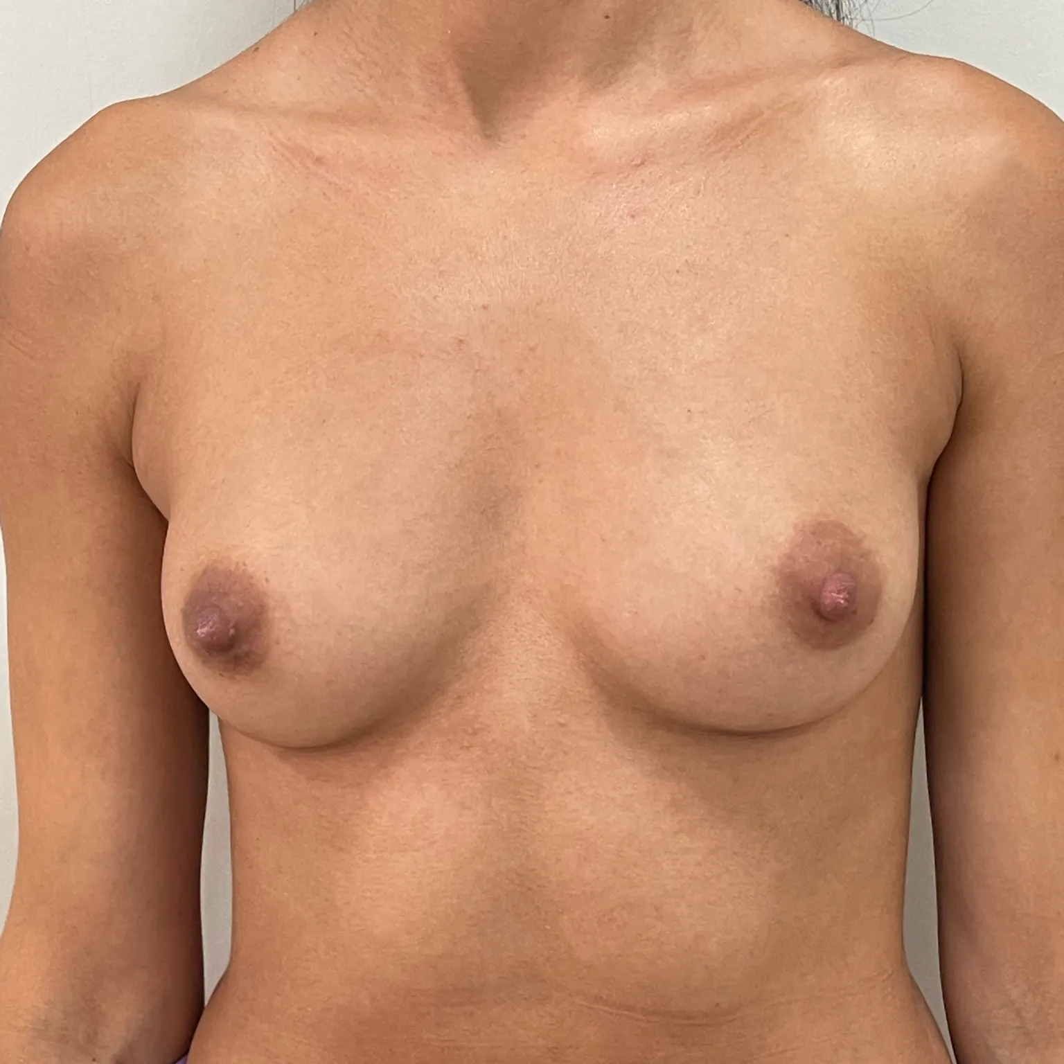 Antes - Otro caso aumento de pecho