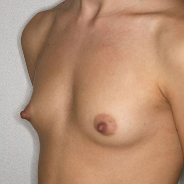 Antes - Otro caso aumento de pecho