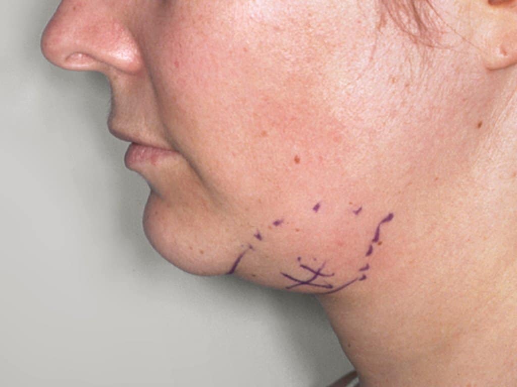 Antes - liposuccion papada