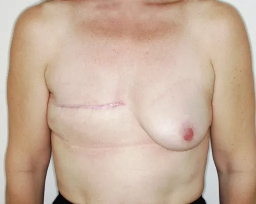 Antes - Otro caso aumento de pecho