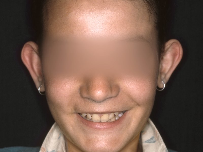 Antes - otoplastia