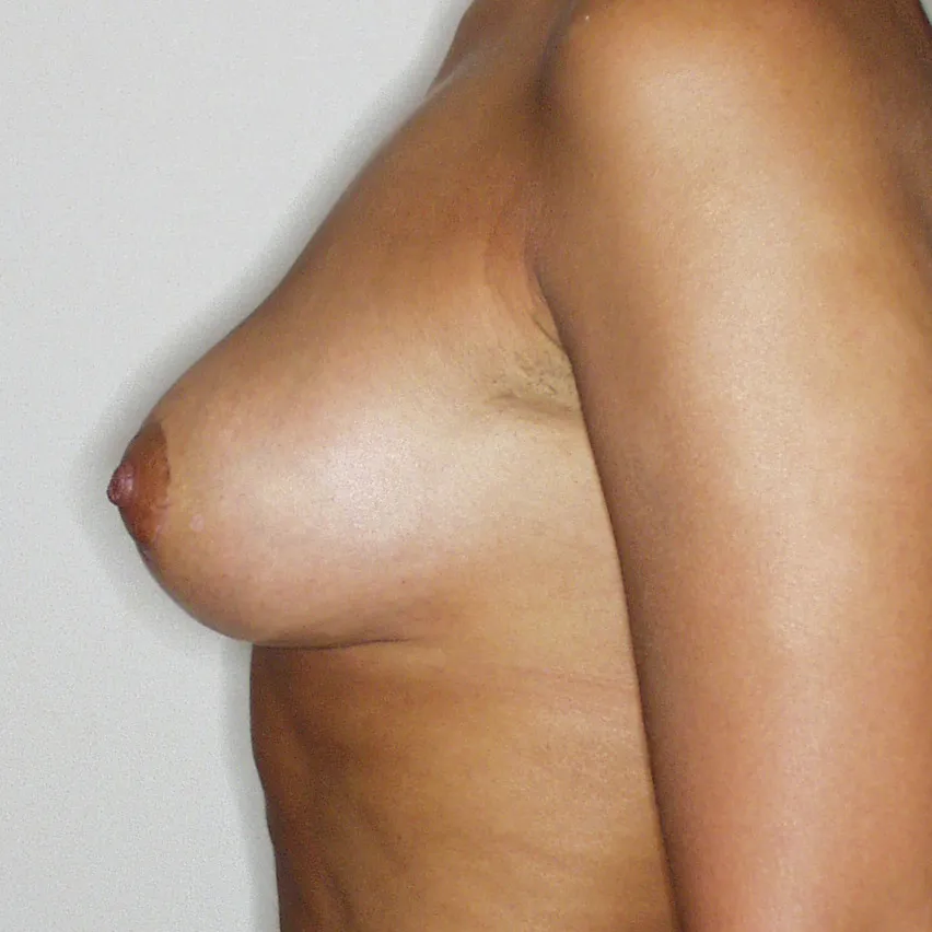 Después - Otro caso aumento de pecho